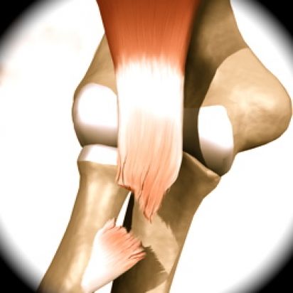 Lesão do Bíceps Distal