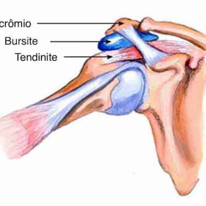 Tendinite e Bursite