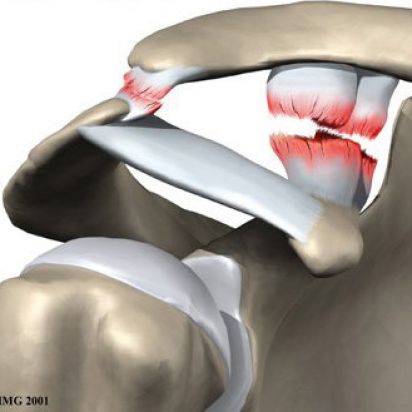 Luxao Acromioclavicular