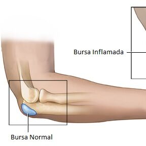Bursite OlecrianaAcessar