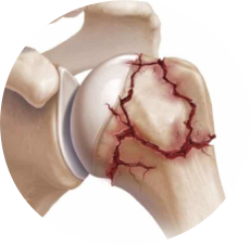 Fratura do Úmero ProximalAcessar