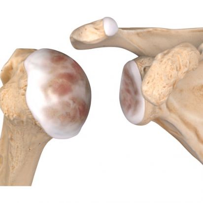 Artrose do OmbroAcessar