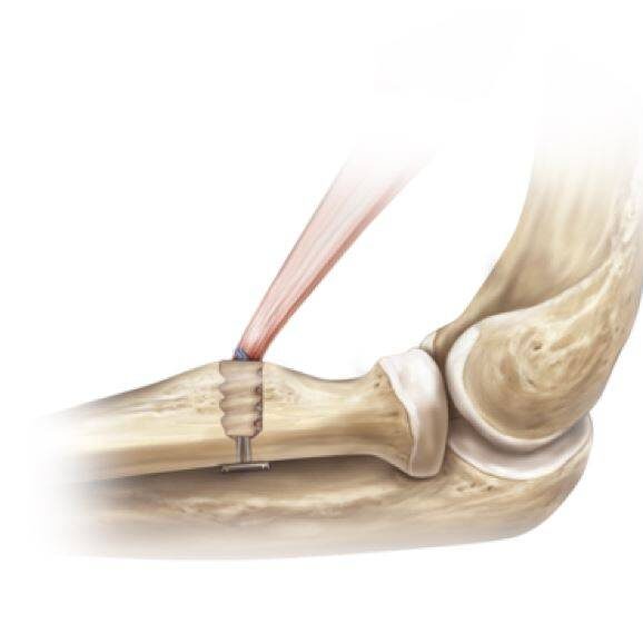 Lesão do Bíceps DistalAcessar