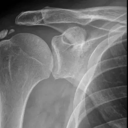 Tendinite CalcáriaAcessar