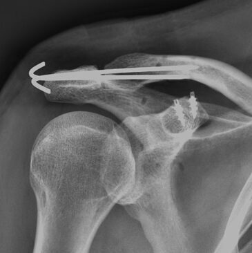 Luxação do ombroAcessar